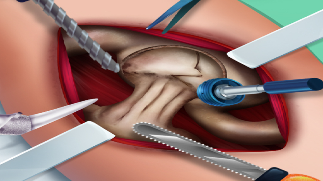Play Ella Hip Surgery For Free Online