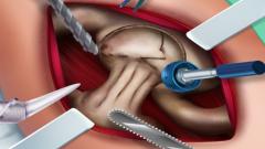 Play Ella Hip Surgery Game Android Online Now